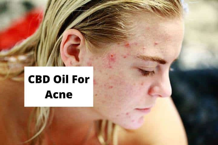 CBD Oil For Acne