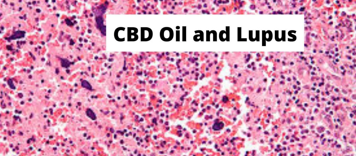 CBD Oil and Lupus